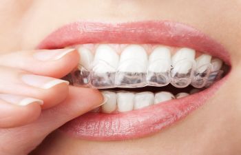 clear orthodontic aligners